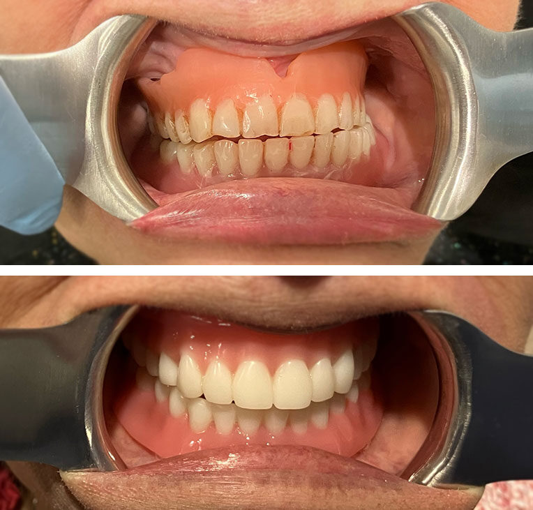 Before and after of cosmetic dental work on a Cary patient